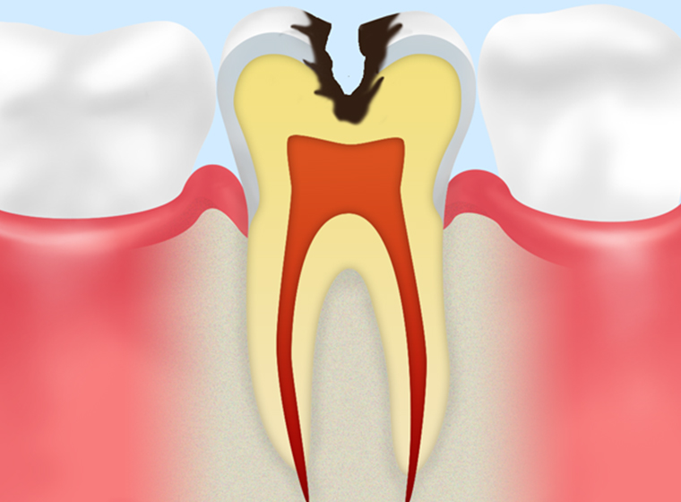 C2：象牙質のむし歯