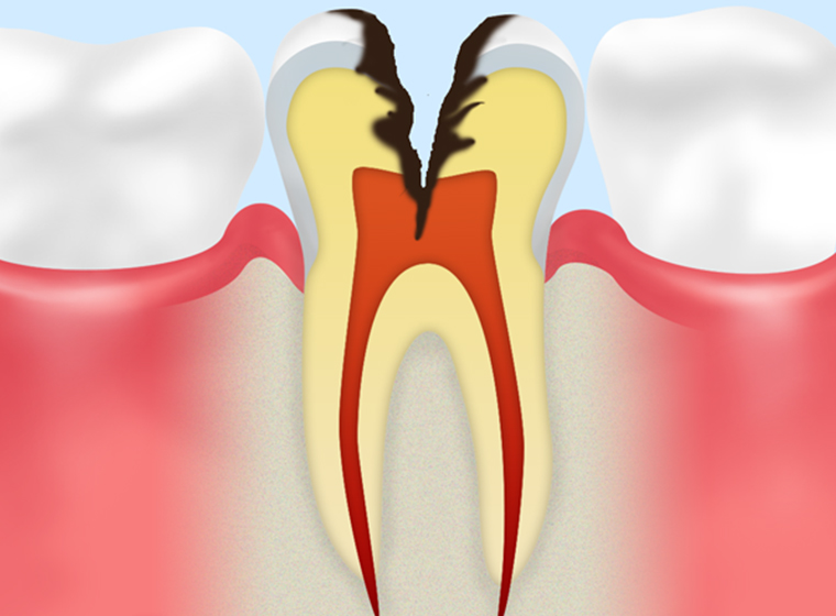 C3：歯の神経に達したむし歯