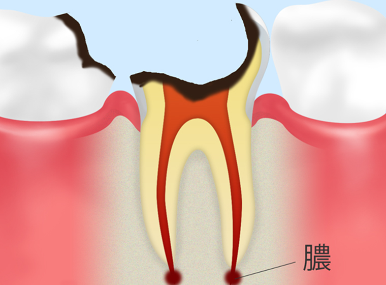 C4：歯根に達したむし歯