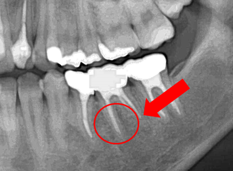 奥歯の症例