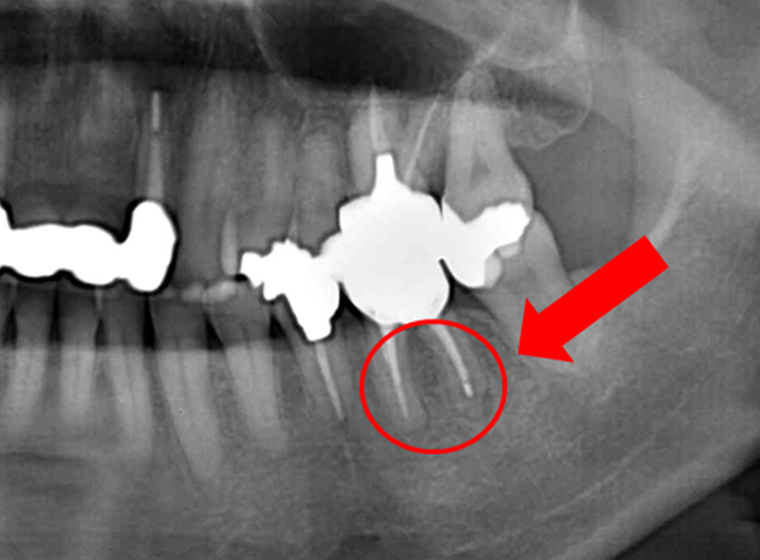 奥歯の症例