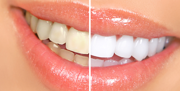 ホワイトニング～白く美しい歯に～