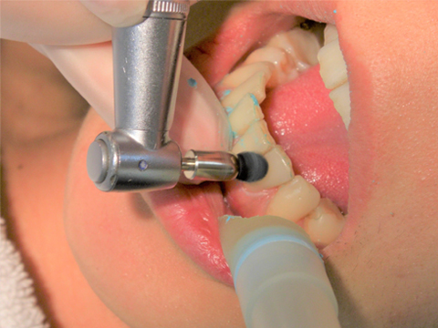 STEP1：歯のクリーニング
