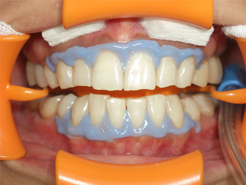 STEP2：歯ぐきの保護