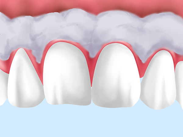 歯ぐきのホワイトニング