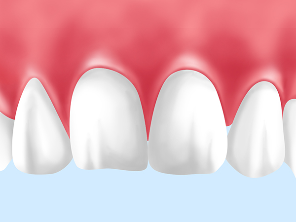 歯ぐきのホワイトニング