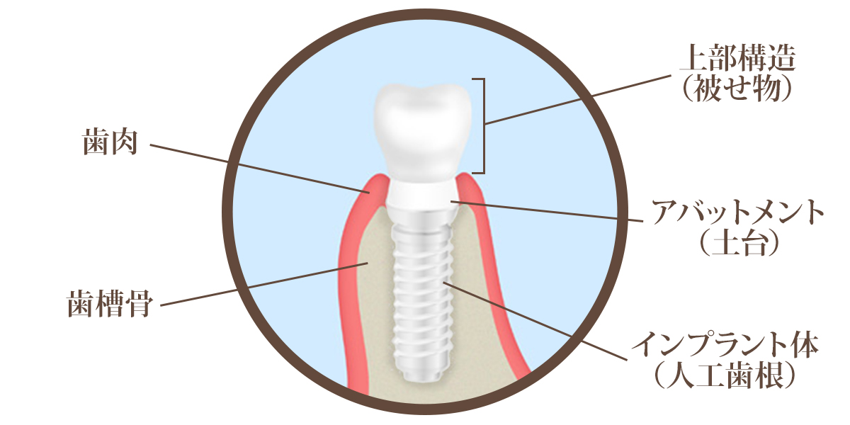 ジルコニアインプラントの特徴
